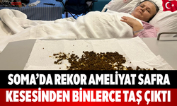 Soma’da rekor ameliyat Safra kesesinden binlerce taş çıktı