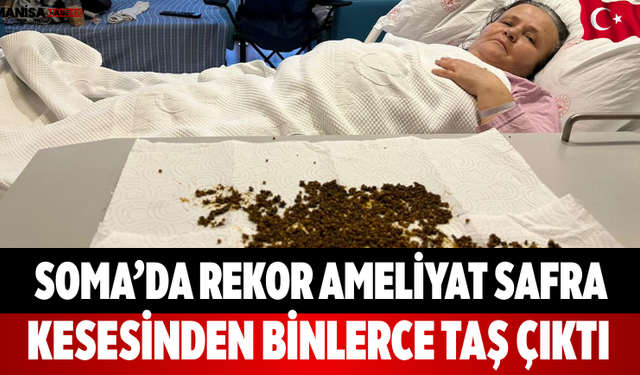 Soma’da rekor ameliyat Safra kesesinden binlerce taş çıktı