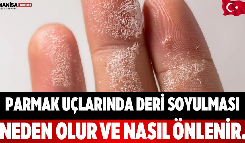 Parmak Uçlarında Deri Soyulması Neden Olur ve Nasıl Önlenir.