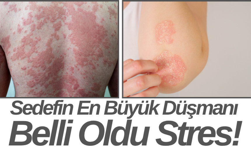 Sedefin En Büyük Düşmanı Belli Oldu Stres!