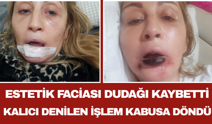 Estetik Faciası Dudağı Kaybetti Kalıcı Denilen İşlem Kabusa Döndü
